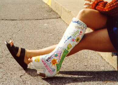 #24-614 Leila - plaster short leg walking cast