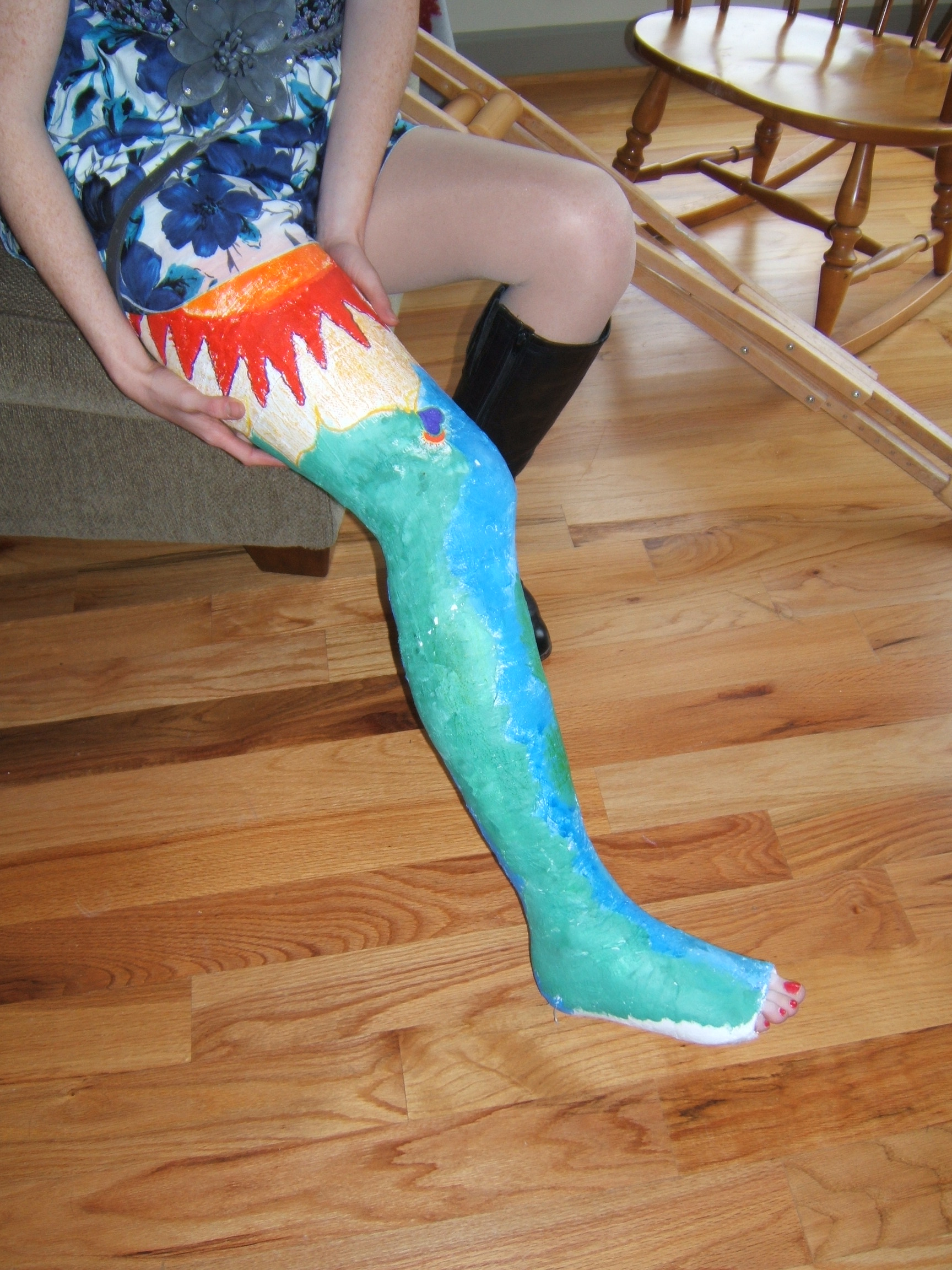 Lacey - plaster long leg cast 