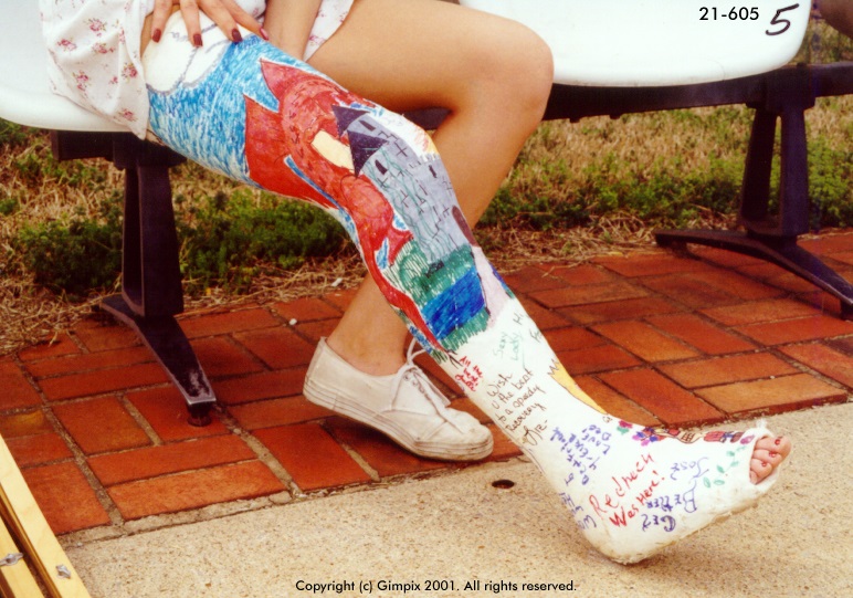#21-605 Kelly - plaster long leg cast 