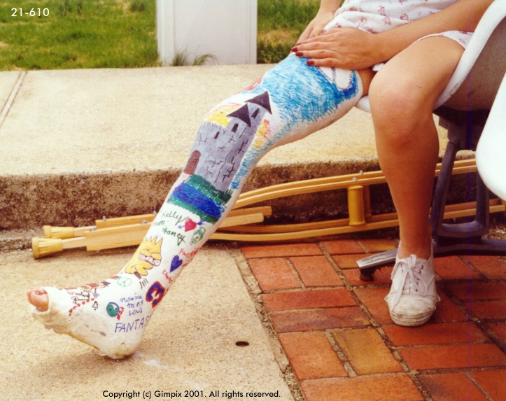 #21-610 Kelly - plaster long leg cast